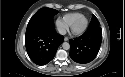 File:Brain metastases from squamocellular lung cancer (Radiopaedia 56515-63219 B 46).jpg