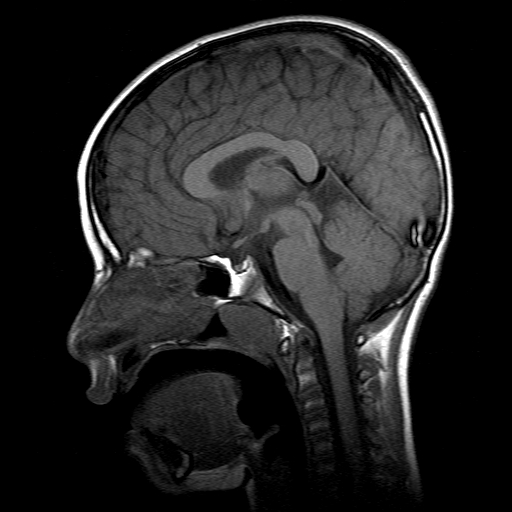 File:Brainstem ganglioglioma (Radiopaedia 10763-11224 Sagittal T1 10).jpg