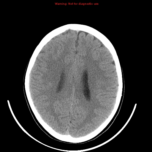 File:Brainstem glioma (Radiopaedia 9444-10123 non-contrast 16).jpg