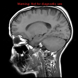File:Brainstem glioma (Radiopaedia 9444-10124 Sagittal T1 2).jpg