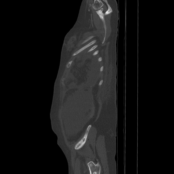 Breast cancer metastases - hepatic and skeletal (Radiopaedia 34201-35461 Sagittal bone window 83).jpg