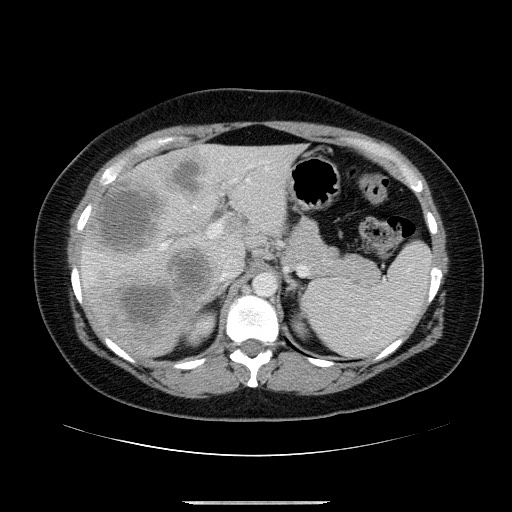 File:Breast cancer pseudocirrhosis after chemotherapy (Radiopaedia 65407-74456 Axial 11).jpg