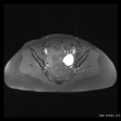 File:Broad ligament fibroid (Radiopaedia 49135-54241 Axial T1 fat sat 16).jpg