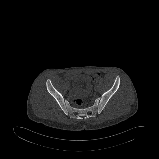 Brodie abscess- femoral neck (Radiopaedia 53862-59966 Axial bone window 78).jpg