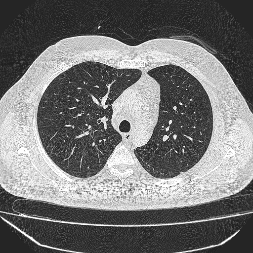 File:Bronchial atresia (Radiopaedia 58271-65417 Axial lung window 16).jpg