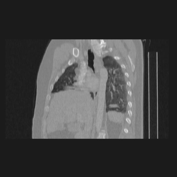 Bronchial atresia (Radiopaedia 60685-68439 Sagittal lung window 43).jpg