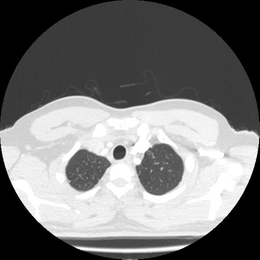 Bronchial carcinoid (Radiopaedia 80013-93291 Axial lung window 1).jpg