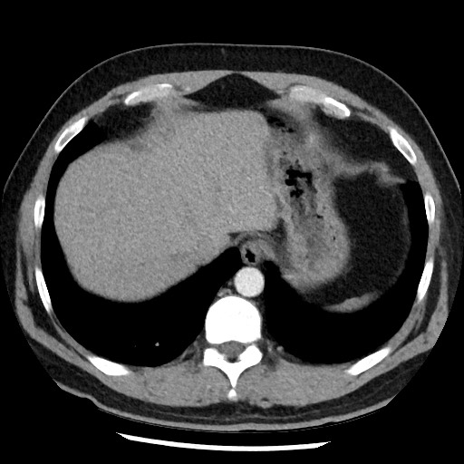 File:Bronchial carcinoid tumor (Radiopaedia 67377-76764 A 51).jpg