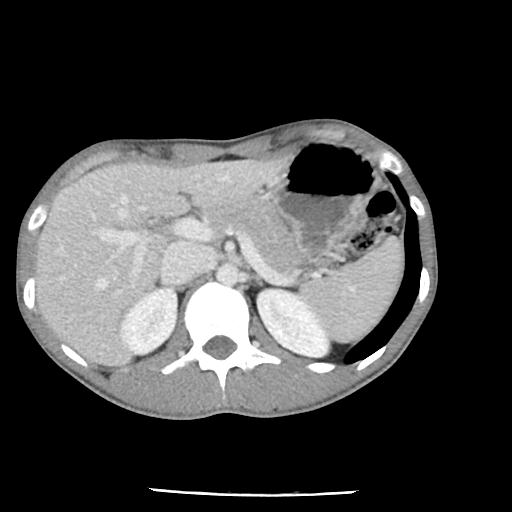 Bronchial carcinoid tumor causing right lower lobe collapse (Radiopaedia 83495-98594 A 56).jpg
