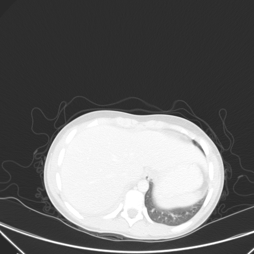Bronchial mucoepidermoid carcinoma (Radiopaedia 57023-63895 Axial lung window 102).jpg
