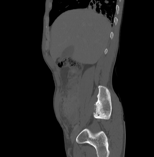 Bronchiectasis in Crohn disease (Radiopaedia 60311-67977 Sagittal bone window 51).jpg