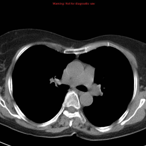 File:Bronchoalveolar carcinoma (BAC) (Radiopaedia 13436-13392 Axial non-contrast 23).jpg