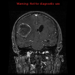 File:Bronchogenic carcinoma brain metastasis (Radiopaedia 9286-9969 Coronal T1 15).jpg
