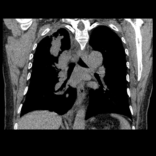 File:Bronchogenic carcinoma with metastatic lymphadenopathy (Radiopaedia 37671-39569 Coronal non-contrast 29).jpg