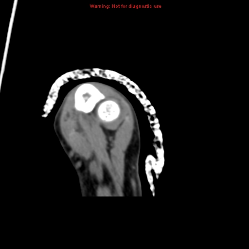 File:Brown tumor (Radiopaedia 12460-12694 Axial non-contrast 127).jpg