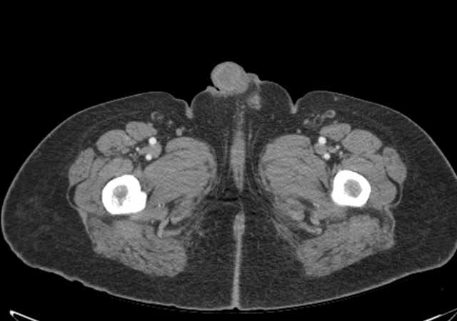 File:Brown tumors compressing the spinal cord (Radiopaedia 68442-77988 E 143).jpg