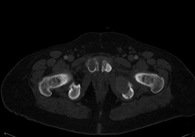 Brown tumors compressing the spinal cord (Radiopaedia 68442-77988 G 128).jpg