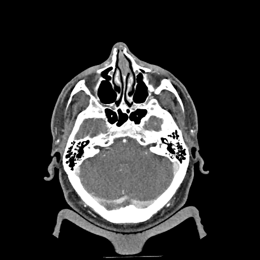 Buccal fat pad arteriovenous malformation (Radiopaedia 70936-81144 D 259).jpg