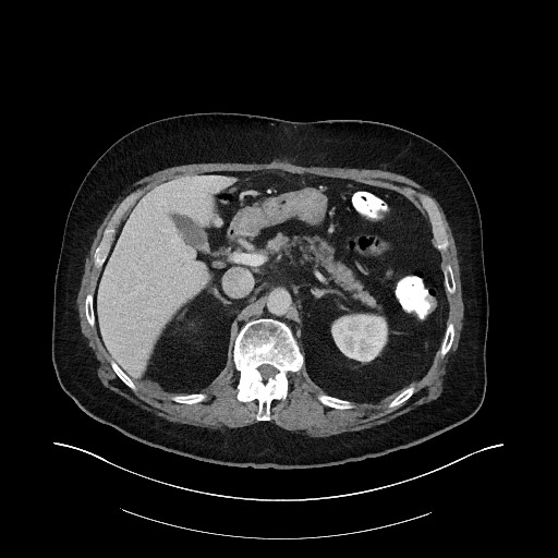 Buried bumper syndrome - gastrostomy tube (Radiopaedia 63843-72575 A 18).jpg