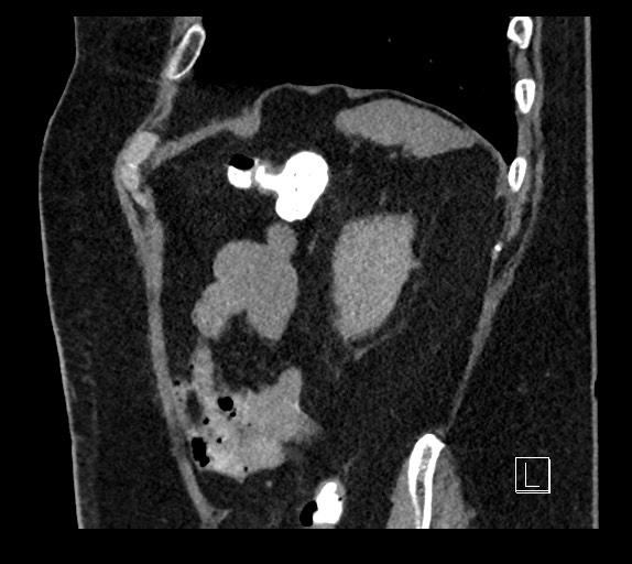 Buried bumper syndrome - gastrostomy tube (Radiopaedia 63843-72577 Sagittal Inject 23).jpg
