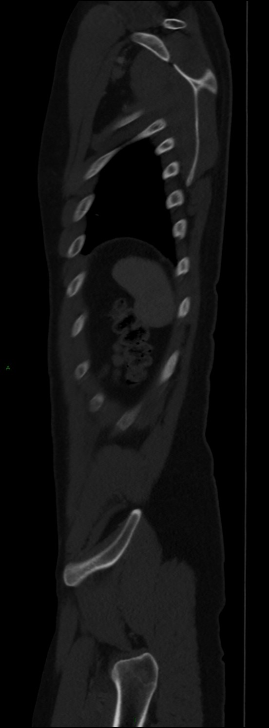 Burst fracture (Radiopaedia 83168-97542 Sagittal bone window 106).jpg