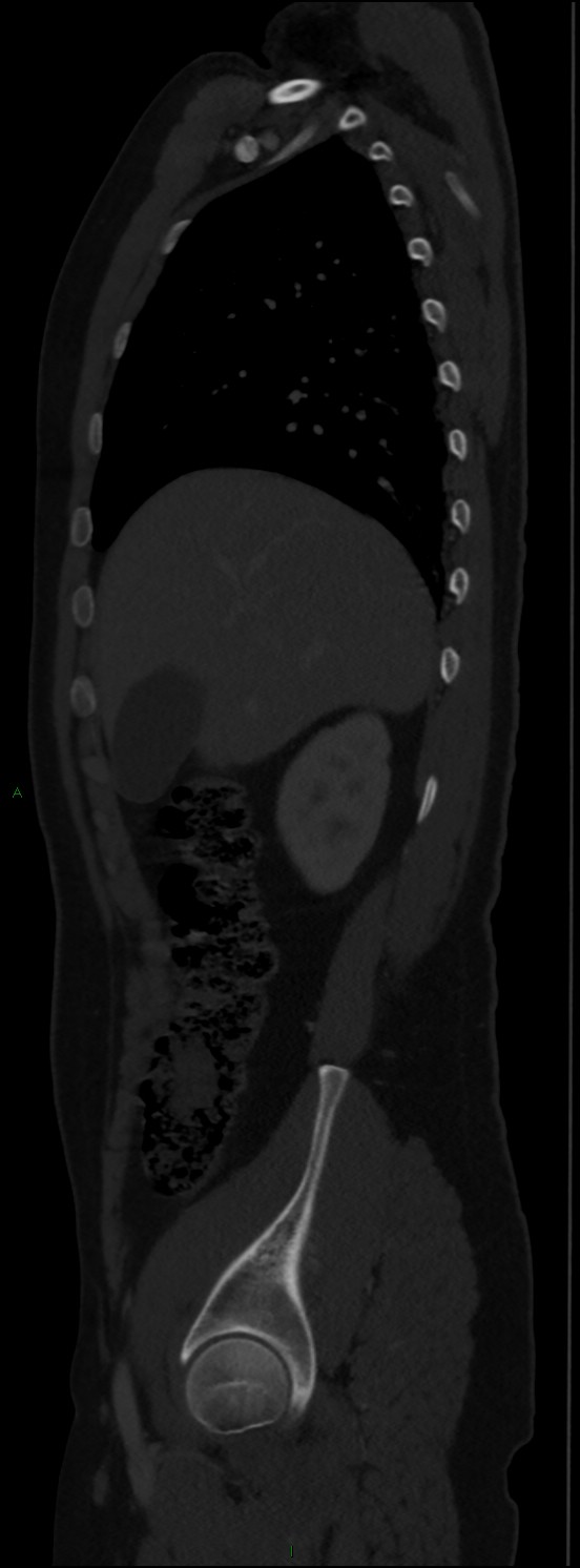 Burst fracture (Radiopaedia 83168-97542 Sagittal bone window 43).jpg