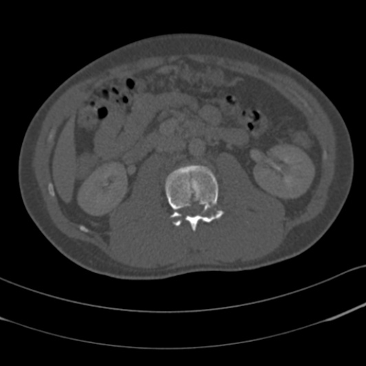 Burst fracture with cauda equina syndrome (Radiopaedia 25701-25867 Axial bone window 51).jpg