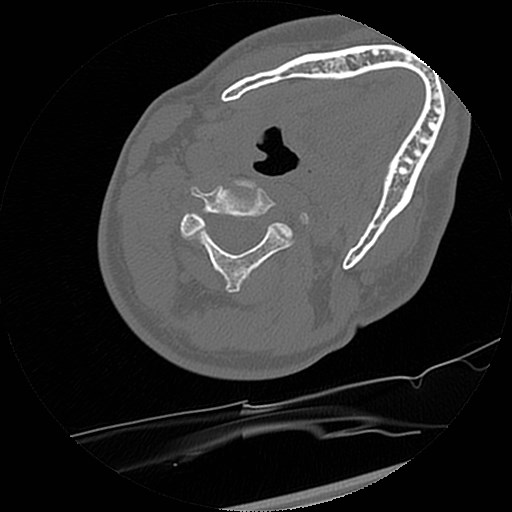 C1-C2 "subluxation" - normal cervical anatomy at maximum head rotation (Radiopaedia 42483-45607 Axial non-contrast 27).jpg