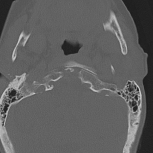 C2 fracture with vertebral artery dissection (Radiopaedia 37378-39199 Axial bone window 8).png