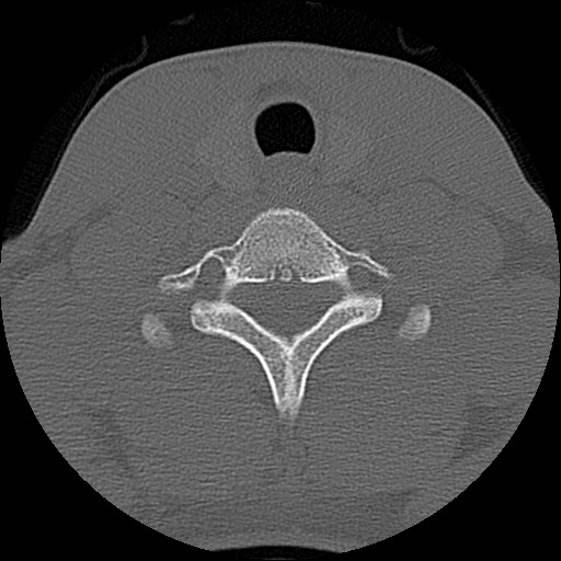File:C5 facet fracture (Radiopaedia 58374-65499 Axial bone window 72).jpg