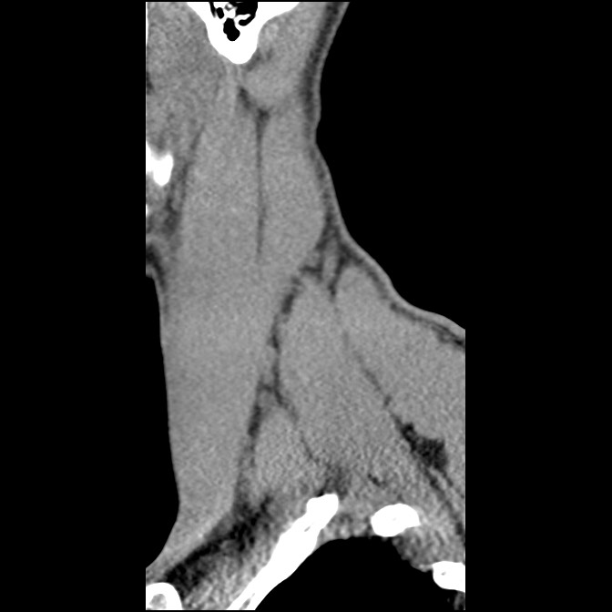 C5 facet fracture (Radiopaedia 58374-65499 D 10).jpg