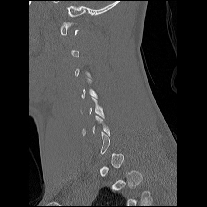 C5 facet fracture (Radiopaedia 58374-65499 Sagittal bone window 50).jpg