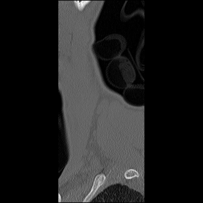 C5 facet fracture (Radiopaedia 58374-65499 Sagittal bone window 6).jpg