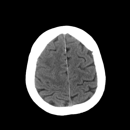 File:CNS lymphoma (Radiopaedia 36983-38639 Axial non-contrast 30).png