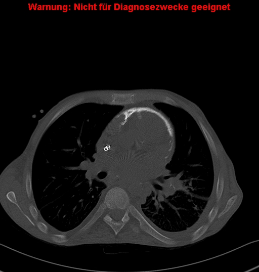 File:Calcific constrictive pericarditis (Radiopaedia 24701-24967 Axial bone window 9).jpg