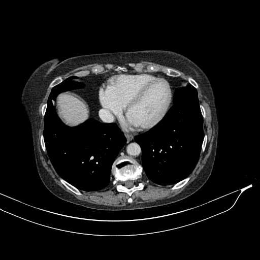 Calcified adrenal glands and Spigelian hernia (Radiopaedia 49741-54988 A 10).jpg