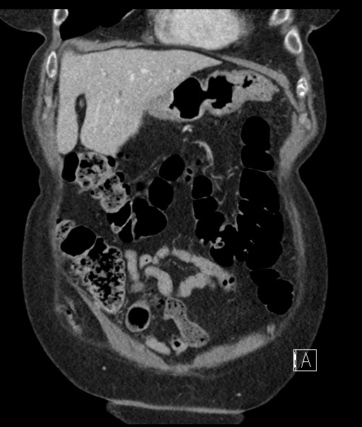 Calcified adrenal glands and Spigelian hernia (Radiopaedia 49741-54988 B 25).jpg