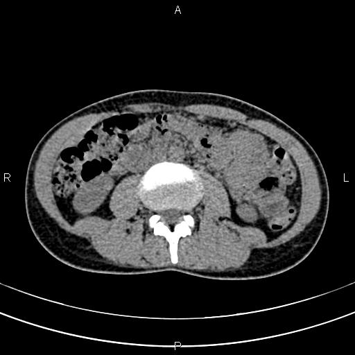 File:Calcified hepatic hydatid cyst (Radiopaedia 83870-99072 Axial non-contrast 94).jpg