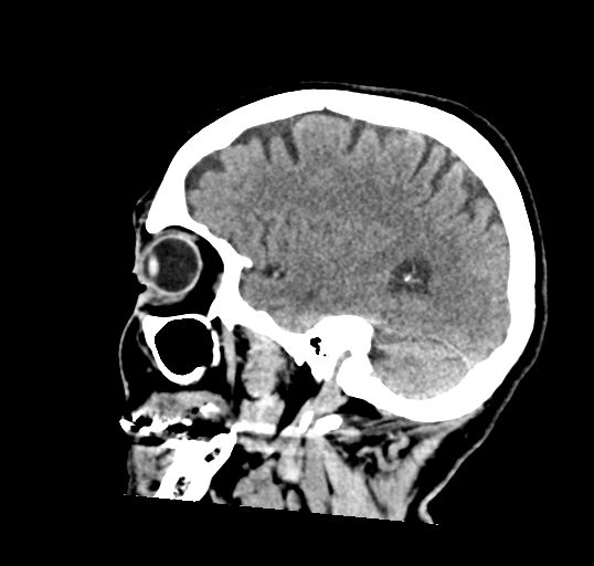 File:Calcified meningioma (Radiopaedia 74361-85243 D 15).jpg