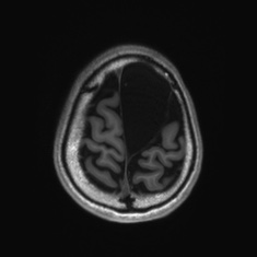 Callosal dysgenesis with interhemispheric cyst (Radiopaedia 53355-59335 Axial T1 136).jpg