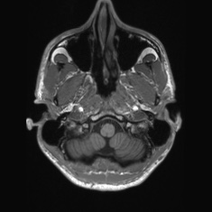Callosal dysgenesis with interhemispheric cyst (Radiopaedia 53355-59335 Axial T1 17).jpg