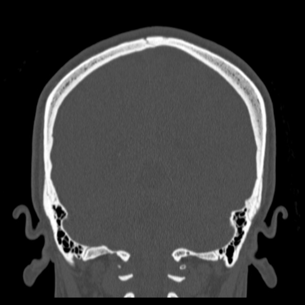 Calvarial osteoma (Radiopaedia 36520-38079 C 65).jpg
