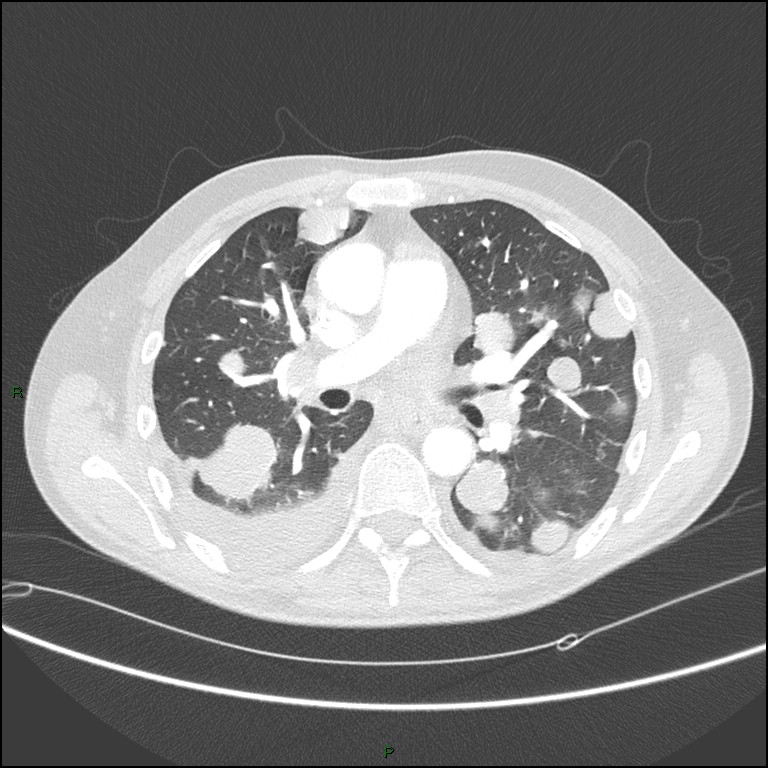 Cannonball metastases (Radiopaedia 82110-96150 Axial lung window 95).jpg