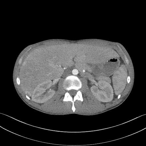 Cannonball metastases - testicular choriocarcinoma (Radiopaedia 84510-99891 B 118).jpg