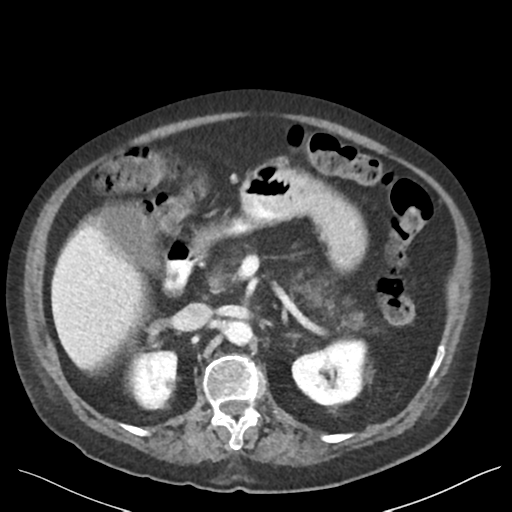 Cannonball metastases from endometrial cancer (Radiopaedia 42003-45031 E 29).png