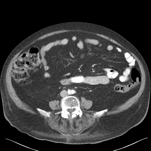 Cannonball metastases from endometrial cancer (Radiopaedia 42003-45031 E 46).png