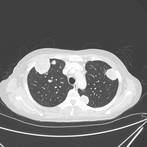 Canonball lung metastasis (Radiopaedia 77634-89837 Axial lung window 47).jpg