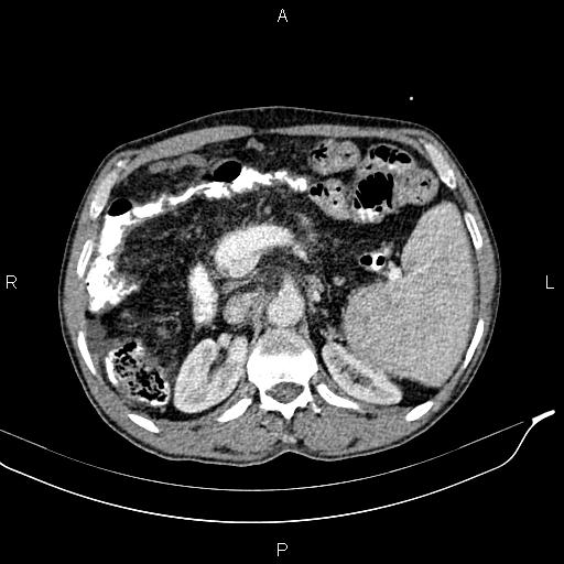 File:Caput medusae sign - portal hypertension (Radiopaedia 64007-72759 A 30).jpg