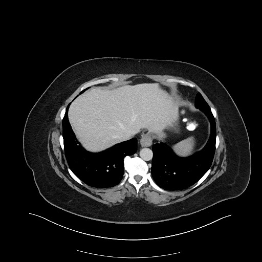 Carcinoid tumor - terminal ileum (Radiopaedia 60931-68739 A 17).jpg