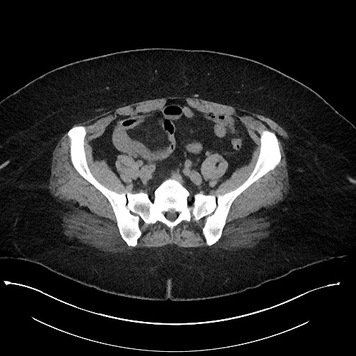 Carcinoid tumor - terminal ileum (Radiopaedia 60931-68740 Axial non-contrast 87).jpg